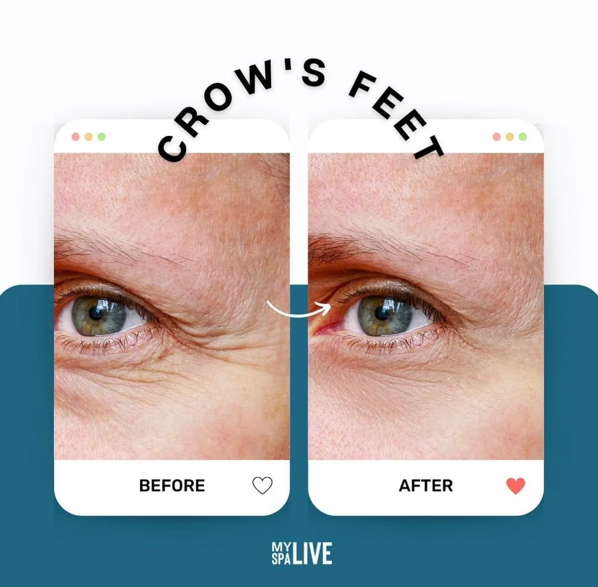 A person 's eye before and after crows feet